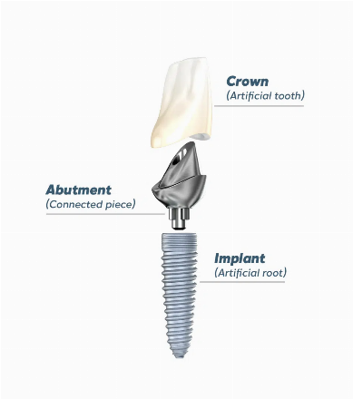 Swiss & German Basal dental implants - single tooth implant