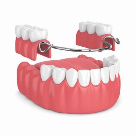 Wironit combined dentures