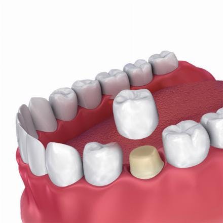 Zirconium crown