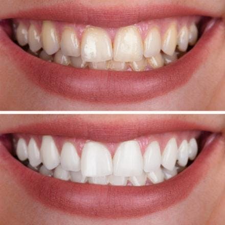 Office teeth whitening