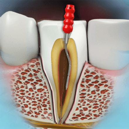 Endodontic treatment of a vital tooth