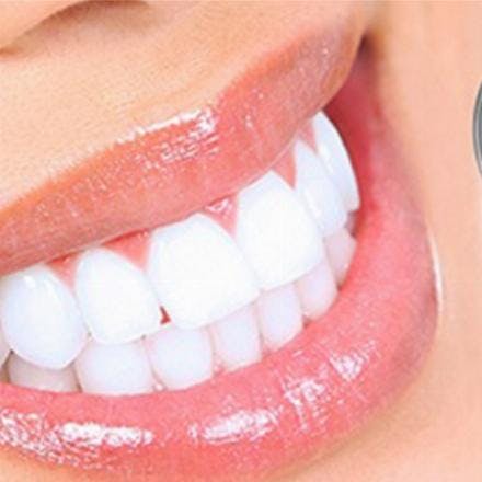 Professional teeth whitening