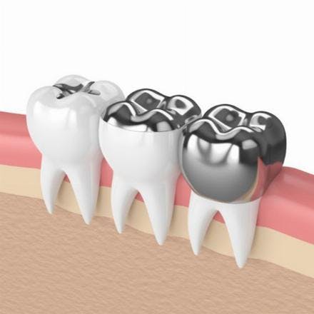 Amalgam fillings (black filling)