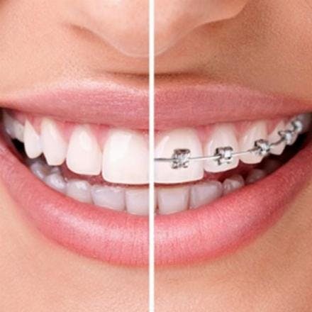 Self-ligating brackets: in-ovation (metal - one jaw)