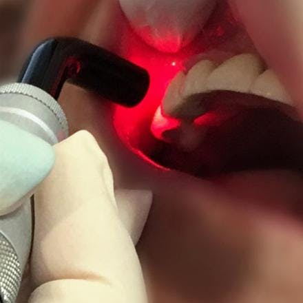 Periodontal laser therapy