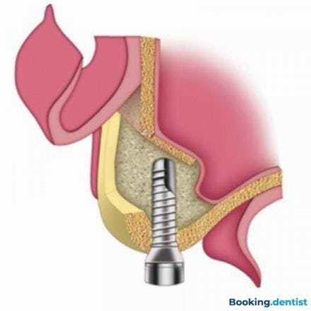 Large Sinus Lifting