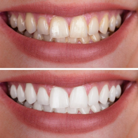 Professional teeth whitening