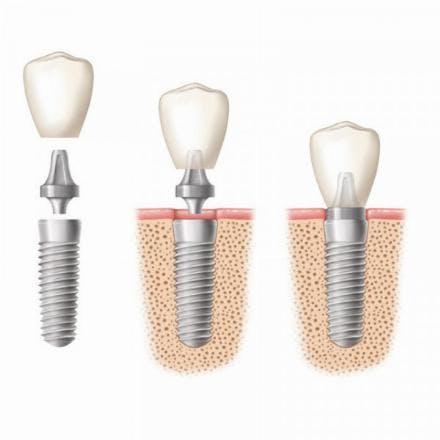 Abutment zircon