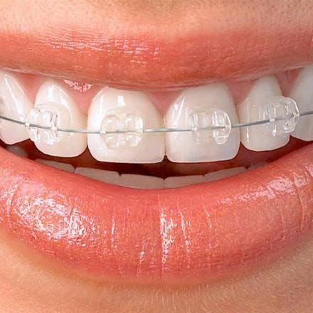 Fixed esthetic dental braces (one jaw)