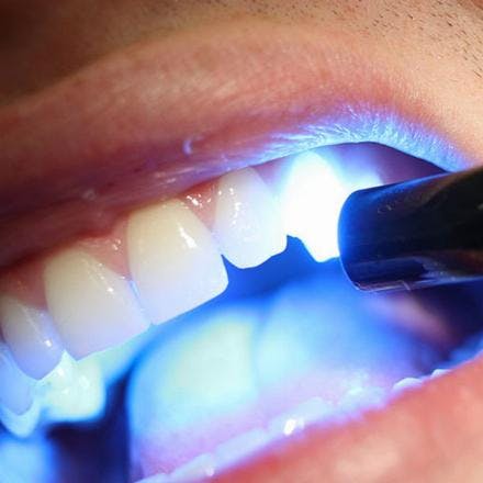 Laser teeth whitening