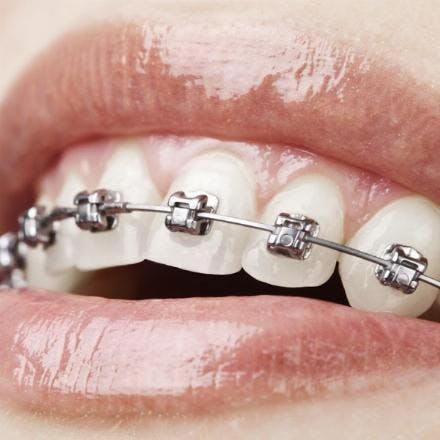 Fixed dental braces (one jaw)