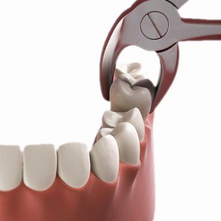 Surgical tooth extraction