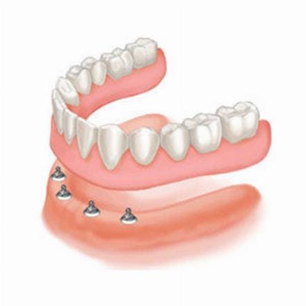 Denture supported by 4 implants with locators (hybrid dentures)