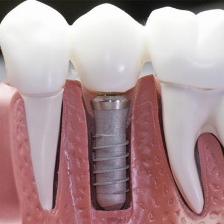 Implant insertion with abutment and metal ceramic crown