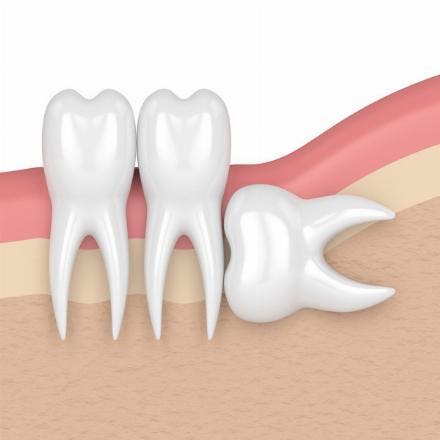 Complicated tooth extraction