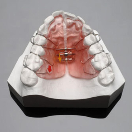 Invisaligne orhtodontic device (one jaw)