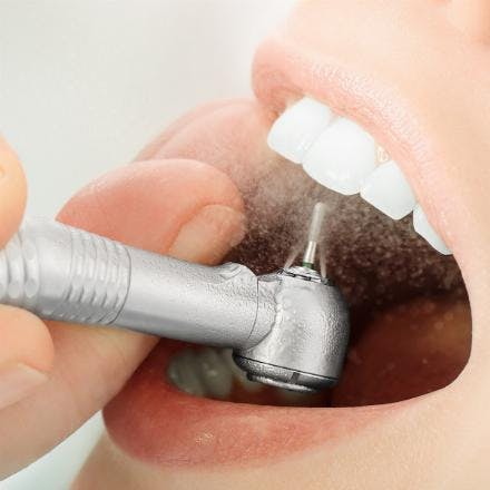 Sandblasting for teeth with air flow method (removal of pigmentation)