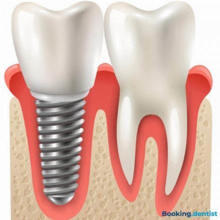 Metal-ceramic crown on implant