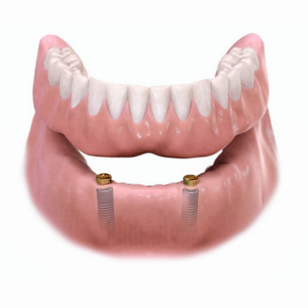 Denture supported by 2 implants with locators (hybrid dentures)