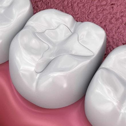 Composite fillings (white fillings)